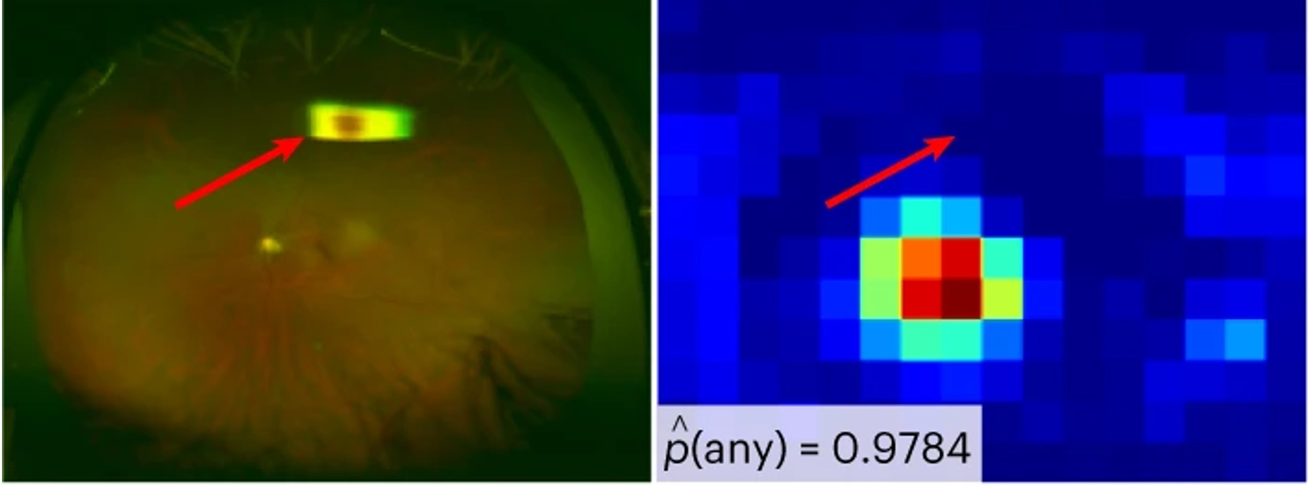 An image showing a ultra-widefield retinal image and a heatmap next to it, representing where the AI model is focusing. The heatmap denotes a high probability of disease in the bottom left corner. A red arrow shows that a reflection artefact in the image is correctly ignored by the model.